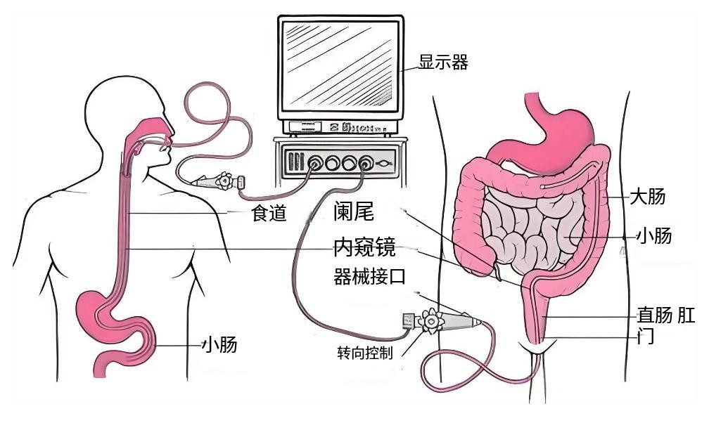 腸胃鏡演示圖